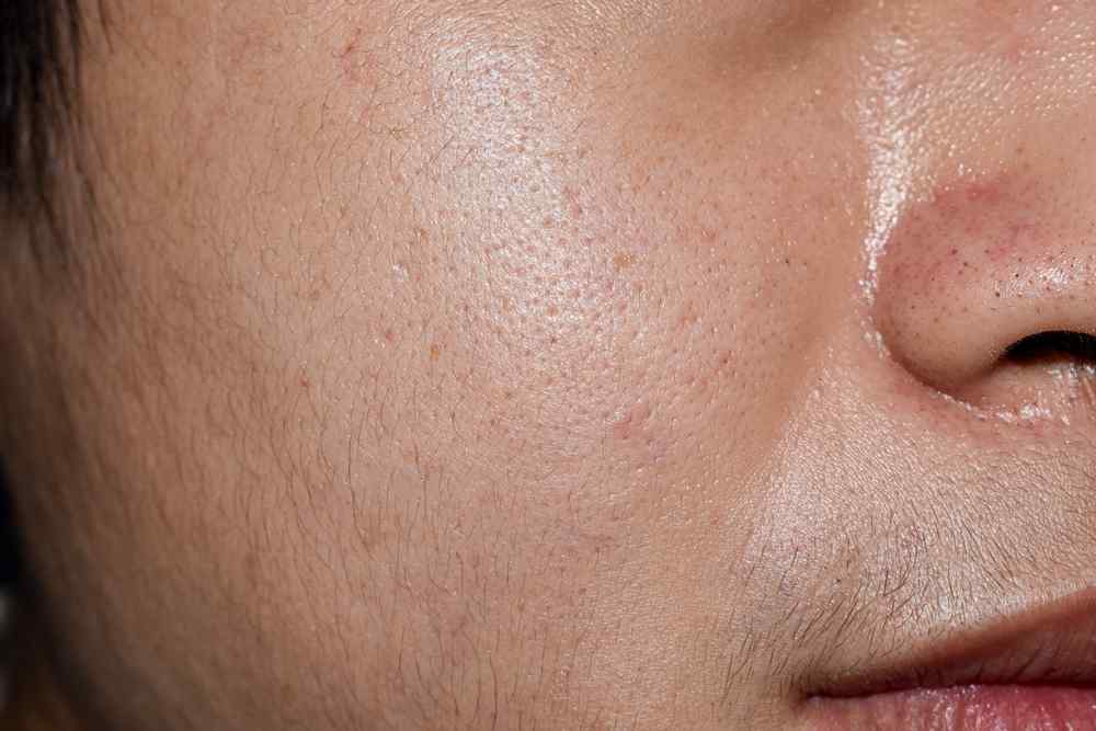 does oily skin affect beard growth